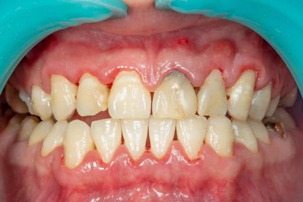 Symptome einer Parodontose oder Parodontitis Erkrankung